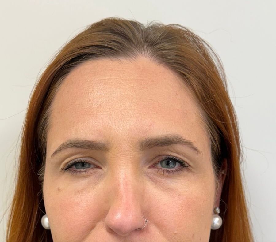 Botox em Curitiba na clínica de estética AURIÊ no Batel