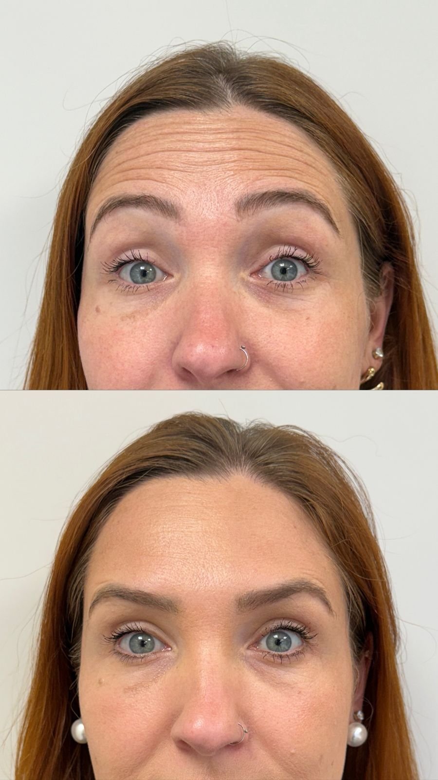 Botox para rejuvenescimento na clínica de estética AURIÊ no Batel em Curitiba