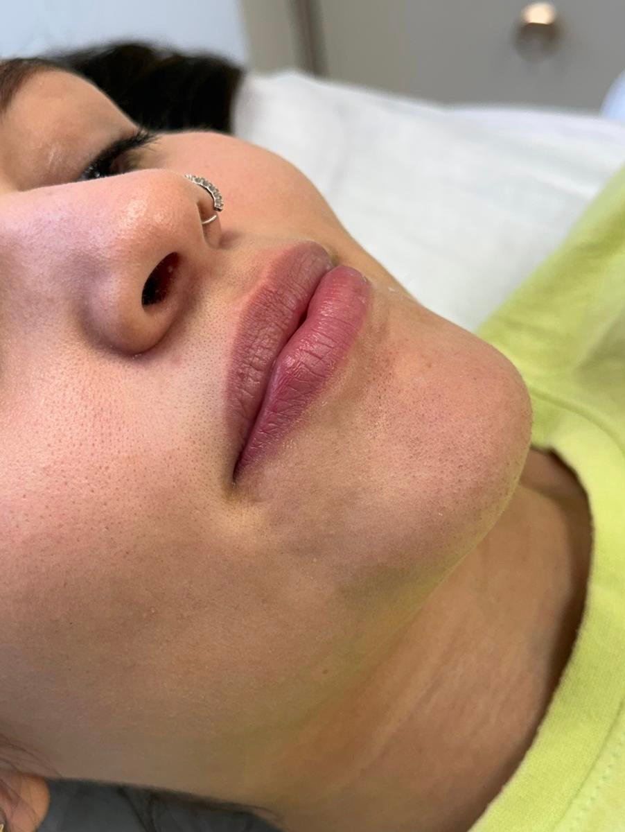 Antes do preenchimento labial na clínica de estética AURIÊ no Batel em Curitiba