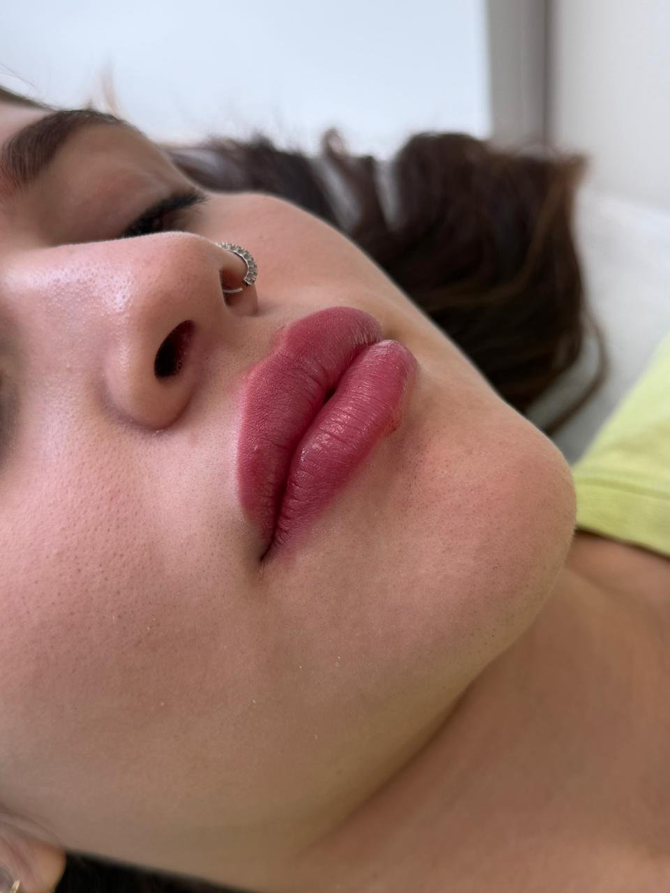 Depois do preenchimento labial com resultado natural na clínica AURIÊ